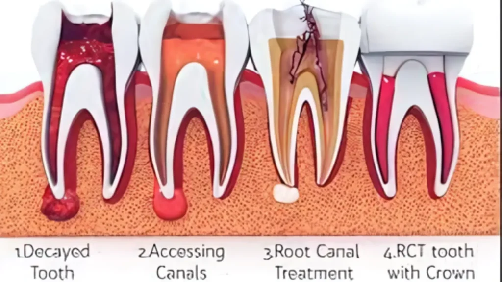 How Much Does a Root Canal Cost